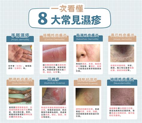 手掌癢徵兆|莫名皮膚癢怎麼辦？10種可能原因公開：濕疹、糖尿病。